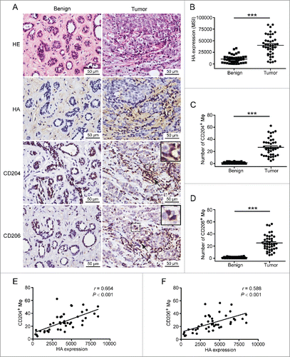 Figure 1. The amount of M2 macrophages is correlated with HA expression in human breast malignant tissues. (A) Immunohistochemical analysis showing HE staining, HA content, CD204+ macrophages, and CD206+ macrophages in human breast benign and malignant tissues. Shown are representative images from 40 patients with breast benign diseases and 42 breast cancer patients. (B–D) Scatter plots showing levels of HA (B), CD204+ macrophages (C), and CD206+ macrophages (D) in tissue samples of patients with breast cancer (n = 42) and benign diseases (n = 40). ***p < 0.001 by Student's t-test. (E, F) Scatter plots showing the positive correlation between HA expression and the number of CD204+/CD206+macrophages in tissue samples of breast cancer patients (n = 42). Pearsons' coefficient tests were performed to assess statistical significance.