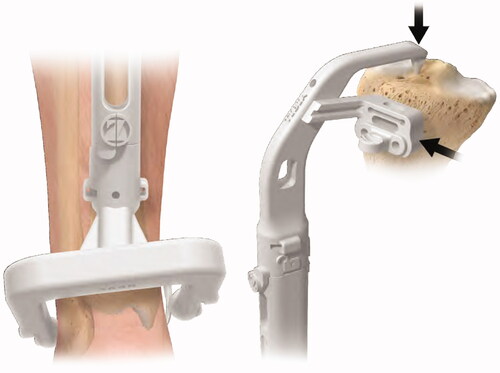Figure 4. Placement of the X-PSI™ tibial guide. The X-PSI™ tibial guide’s patient specific ankle clamp was placed around the patient’s malleoli. Then, the pointer at the proximal end of the guide was placed on the tibia’s mechanical axis entry point, making sure the guide contacted the anterior surface of the tibia. The tibial guide was aligned in the axial plane with the medial third of the tuberosity and posterior cruciate ligament (PCL) insertion.