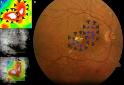 Figure 2 Example of spectral-domain optical coherence tomography (SD-OCT) guidance of macular laser photocoagulation. Retinal thickness color map (A) obtained by SD-OCT software; a fundus photograph (B) is also registered; finally, a composition of the map superimposed and aligned on the fundus image is provided automatically by SD-OCT (C). The equivalent color fundus photograph (D) is used to show the laser spot location mapping (blue asterisks) avoiding the foveal area.