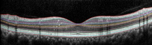 Figure 1 Retinal segmentation. Retinal segmentation as performed by the software for the SD-OCT (Spectralis): a - retinal nerve fiber layer (RNFL), b - ganglion cell layer (GCL), c - inner plexiform layer (IPL), d - inner nuclear layer (INL), e - outer plexiform layer (OPL), f - outer nuclear layer (ONL) and g - retinal pigment epithelium (RPE).