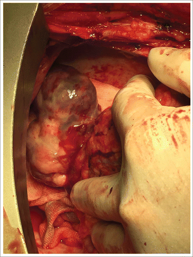 Figure 2. Surgical exploration reveals a firm 40 mm × 30 mm × 30 mm mass with coronary infiltrated.