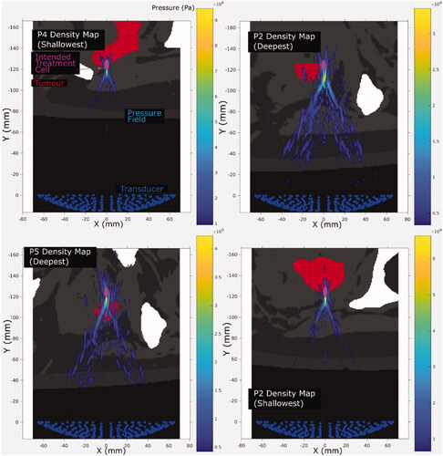 Figure 5. Representative cross-sections of simulated acoustic pressure fields (colour bar, only pressures >10% of focal peak pressure are shown) overlaid on the density map (grayscale, lighter means denser, that is, bone is white and oil is black) used for different patients and exposure points. The intended treatment cell (magenta, 4 mm wide, 10 mm long, centered at the geometric focus) is also shown relative to the tumor (red). Each cross-section is the slice in which the peak focal pressure lies.