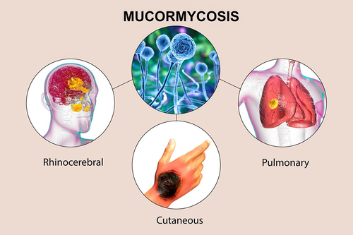 Figure 1. Clinical manifestations of infection by Mucorales fungi. Following inhalation of air-borne sporangiospores released from sporangia (blue structures), rapidly progressive angio-invasive infections of the paranasal sinuses by invasive hyphae can lead to rhino-orbital-cerebral mucormycosis (ROCM). ROCM is categorized as: localized sinus, localized orbital, localized cerebral, sino-orbital, sino-cerebral, rhino-cerebral and generalized ROCM. Inhalation of spores into the lungs can result in localized and deep extension (infections involve the lungs, chest wall, heart, artery or aorta) pulmonary mucormycosis, while necrotizing cutaneous mucormycosis caused by traumatic implant of infective propagules in the skin can lead to disseminated disease of the lungs, liver, spleen, heart, and other organs following hematogenous spread of Mucorales fungi from the sites of infection. Image courtesy of Shutterstock.