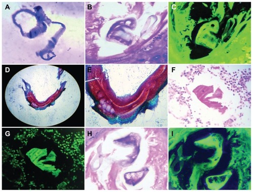 Figure 6 Embryoid bodies showing somites characteristic of embryologic segmentation, identified in (A), showing a case of peritoneal carcinomatosis ascitic fluid, Papanicolaou staining (40×). (C) Negative image of (B) in a case of malignant eccrine poroma. (D and F) Somite-like segmentation in an embryoid body found in a case of papillary thyroid carcinoma, fine needle biopsy, Papanicolaou staining (40×). (G) Negative image of (F) in a case of gastric adenocarcinoma, hematoxylin and eosin staining (20×). (I) Negative image of (H) in a case of colon adenocarcinoma, hematoxylin and eosin staining (40×).