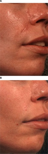 Figure 2 Hypertrophic and erythematous surgical scar before (A) and after two pulsed dye laser (PDL) treatments (B).