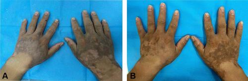Figure 4 Topical use of Hirudoid twice a day for a month and symptoms were partially relieved (A and B).