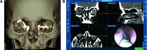 Figure 6 Case 3: (A) The 3D CT-DCG showed a regularly dilated right lacrimal sac and an abrupt obstruction at the level of the sac–duct junction. The DCG findings of the left lacrimal apparatus showed multiple areas of stenosis at the sac–duct junction and within the nasolacrimal duct. (B) Endoscopic localization of the contrast-filled sac. Note that the green crosshairs depict the accurate localization on all the CT images.