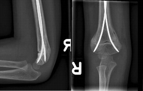 Figure 3. Regular follow-up 2 months after the injury, with free range of motion and normal axis of the elbow joint.