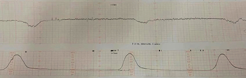 Figure 2 Fetal Cardiotocography of Case 3.