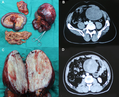 Figure 2 Clinical picture of patient 1. (A) Giant metastatic tumor of mesentery; (B) Computed tomography (CT) images; (C) Tumor section specimen; (D) Arterial dominant phase of CT shows arterial enhancement of nodule measuring 10.0 cm in diameter.