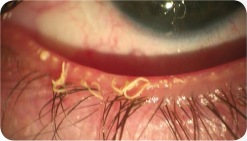 Figure 3 Meibomian gland dysfunction: strings of waxy, dysfunctional meibomian secretion.