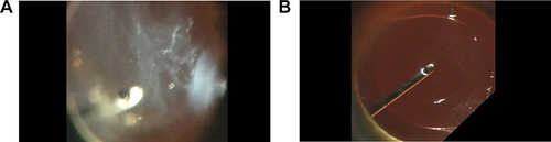 Figure 1 (A) [Before] Image of Vitreous Opacity Vitrectomy (VOV) removing extensive vitreous opacities. (B) [After] Image of a clear visual axis following VOV.