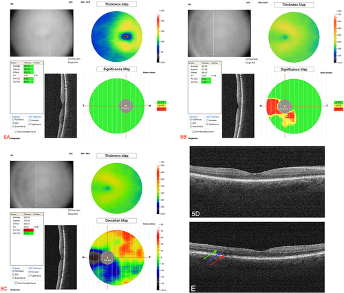 Figure 5 (A) Optical coherence tomography (OCT) ganglion cell analysis: Normal macular profile OD. Significance mapping: Green is p>5%, yellow is p<5% and red is <1%. Thickness mapping: Blue 50 to ~ 80 microns, green >80 to ~180 microns, yellow >180 to <175 microns. (B) Optical coherence tomography (OCT) ganglion cell analysis: Atrophy of nasal papillary bundle OS. Significance mapping: Green is p>5%, yellow is p<5% and red is <1%. Thickness mapping: Blue 50 to ~ 80 microns, green >80 to ~180 microns, yellow >180 to <175 microns. (C) Optical coherence tomography (OCT) Full thickness analysis: Atrophy of nasal papillary bundle OS. Thickness mapping: Blue 50 to ~ 160 microns, green 200 to ~300 microns, yellow >300 to <370 microns. Deviation mapping: Red: ~25 to 40%, Orange: ~20 to 25%, yellow: −10 to 15%, green −5 to 5%, blue −25 to −15%, black and grey −30 to −50%. (D) Optical coherence tomography (OCT): OD 5 months follow up shows normal macular scan. (E) Optical coherence tomography (OCT): OS macular scan 5 months shows minimal improved architecture of ellipsoid zone, photoreceptor outer segments and interdigitation zone. Blue arrow: Outer nuclear layer; Red arrow: Photoreceptors; Green arrow: Outer plexiform layer.