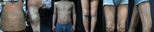 Figure 1 Clinical manifestation of Psoriasis. (a) Skin involvement of more than 80% of the body surface area on admission. The Psoriasis Area and Severity Index (PASI) score was 62. (b) Skin involvement after two sessions of Adalimumab treatment. The PASI score was 12. (c) Skin involvement at 12 weeks after Adalimumab initiation. The PASI score was 1.