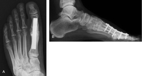 Figure 3. A and B. 6 months after turn around inlay graft.