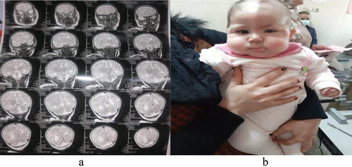 Figure 1. (a) MRI of the brain showing different sizes of both hemispheres; (b), a photo of the child showing asymmetry of the face including eyes (not obscured) after consenting of the mother of the child.