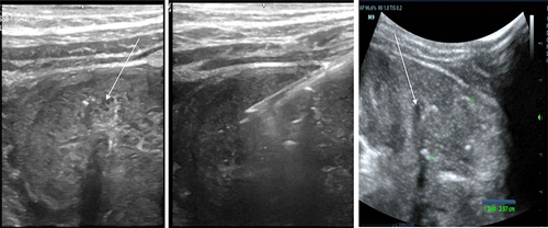 Figure 3 Ultrasound showing guided biopsy for histopathological study. Biopsy is taking from the mass (white arrows).