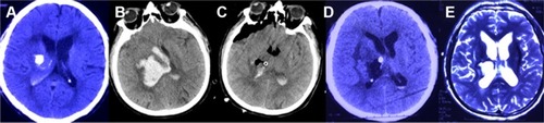 Figure 5 Pre- and post-operation CT scans of a thalamic hemorrhage breaking into the ventricles that was evacuated by neuroendoscopy.