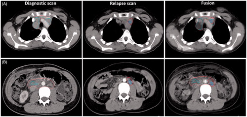 Figure 1. Lymphoma volumes for two patients shown on the diagnostic scan, the relapse scan, and together with the fusion. The fusion was done with rigid image co-registration in the Eclipse treatment planning system. On the diagnostic scan the gross tumor volume (GTV) initially is shown in pink and contains both the PET-positive (GTVPETi shown in cyan) and PET-negative parts of the lymphoma. On the relapse scan GTVr (relapse) is red and the GTVPETr is blue. All structures are shown on the fusion. Patient A (top): clinical stage IIA, relapsed after 6 months in previously involved lymph nodes. Patient B (bottom): clinical stage IIIB with paraaortic bulky disease, relapsed after 6 months within the previously bulky site only.