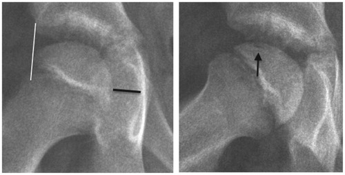 Figure 2. At 2.3 months. Start of extrusion. Subchondral fracture. Early stage Ia.