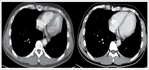 Figure 4. Within 18 months of erlotinib treatment, disease decreased and remained stable persistently.