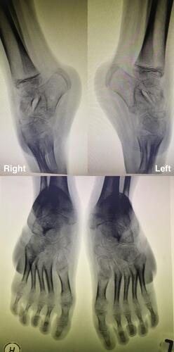 Figure 5 Repeat radiographs prior to posterior ankle release showing improved forefoot abduction.