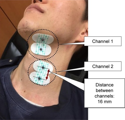 Figure 2 Placement of electrical leads.Notes: Channel 1: Placed on the area over the mylohyoid muscles to represent the suprahyoid muscles. Channel 2: Placed on the area over the sternohyoid muscle to represent the infrahyoid muscles.