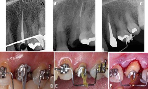 Figure 2 Tooth # 23 during RCT and custom-made post constriction (A–C), orthodontic extrusion (D), and surgical crown lengthening (E and F).