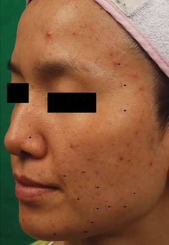 Figure 1. Numerous arcuate brownish crusted lesions (arrows) on the cheek following 1450-nm diode laser treatment equipped with a dynamic cooling device.
