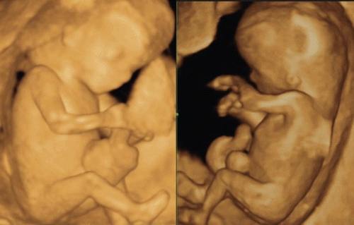 Figure 47.  Omphalocele at 12 and 13 weeks of gestation 3D reconstructed ultrasound images clealy demonstrates omphalocele. Trisomy 18 was confirmed by chorionic villi sampling in both cases.