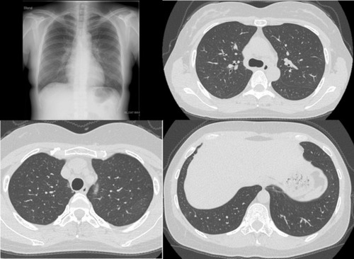 Figure 4 A chest X-ray and chest CT images showed an improvement in lung infiltrates after the discontinuation of natalizumab.