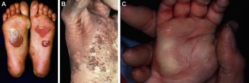 Figure 1 Clinical features of three keratin diseases. (A) Blisters on the soles of a patient with the milder Weber–Cockayne form of epidermolysis bullosa simplex. (B) Widespread epidermolytic hyperkeratosis in a bullous congenital ichthyosiform erythroderma patient. (C) Site-restricted epidermolytic hyperkeratosis of the palms in a mother and child with epidermolytic palmoplantar keratoderma.Note: Reproduced from McLean WI. Genetic disorders of palm skin and nail. J Anat. 2003;202(1):133–141 with permission from John Wiley and Sons.Citation54