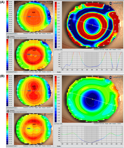 Figure 5 The subtraction map (the larger map) was obtained by subtracting the pre-ortho-k map (upper left) from the post-ortho-k map (lower left). (A) Tangential maps. (B) Axial maps. The subtraction maps show the changes after 7 consecutive nights of lens wear. Images courtesy of Randy Kojima & Patrick Caroline, Pacific University.