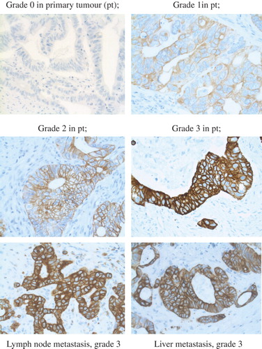 Figure 1. Immunohistochemically detection of HER3 expression CRC primary tumour, grade 0–3 and HER3 expression, grade 3, in lymph node and liver CRC metastasis (magnification × 40).