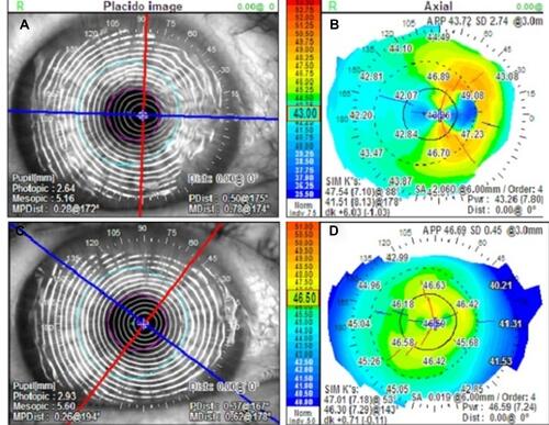Figure 4 Representative topographical changes in the study group. At baseline (A and B) corneal topography showed marked irregular astigmatism and irregular Placido rings. One month after treatment (C and D), the astigmatism markedly reduced from 6D to 1D and the corneal curvature dramatically improved, while the Mean K changed from 43.3 D to 46.6 D along with concurrent ~ 30° axis deviation.