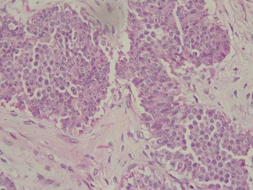 Figure 9 Histological features of ovarian carcinoid. Round to oval tumor cells with pink cytoplasm and centrally located nuclei with salt-and-pepper chromatin, arranged in solid nests (HE x 10).