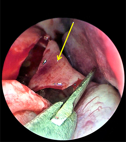 Figure 4 Intraoperative nasal endoscopy. An incision is made in the floor of the left nasal cavity as indicated by the yellow arrow (roof of the NPC), and yellowish, cloudy discharge is drained.