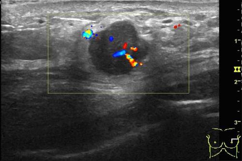 Figure 2 Breast ultrasound showed a 1.5×2.0 × 1.4cm mass in the left breast.