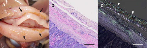Figure 2. Macroscopic and histological features of amyloid deposition in quail. (a) Tan discoloured lesions were found in the serosa of the duodenum. (b, c) Histological image of serial sections of discoloured lesions. Severe amyloid deposition band in the serosal stroma appeared as an acidophilic nonstructural deposit by H&E (b), which stained with Congo red and showed green birefringence under polarized light (c). Bar = 100 μm. Color online.