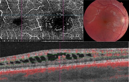 Figure 3 Observations in patient 3. Perifoveal superficial vascular plexus in a 3 × 3 mm fovea-centered OCTA image with supero-nasal interruption of the capillary network (upper left). Hyperreflective retinal abnormalities (ie, microvascular protrusions) within enlarged foveal avascular zone in the pDVP (upper central). B-scan image centered on a dilated capillary shows lack of glial support and protrusion in a schisis cavity in the pDVP. Vascular flow is automatically represented with red color by IMAGEnet®.