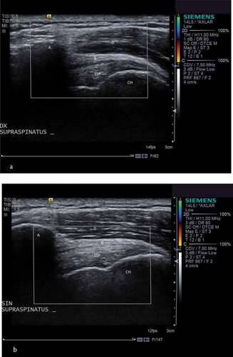 Figure 5. A and b. Ultrasound of both shoulders in a 53 year old male patient with unilateral subacromial pain syndrome.