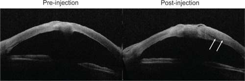 Figure 3 Optical coherence tomography images of Case 1 (pre- and post-injection).