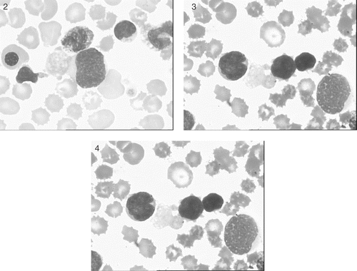 Figures 2–4 Peripheral blood smear showing megakaryoblasts with highly dysplastic large cytoplasmic projections identical to the abundantly present circulating, large, agranular or poorly granular platelets.