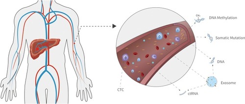 Figure 2 Genetic biomarkers for HCC early diagnosis. Characteristics of the circulating genetic materials can be applied in HCC early diagnosis including somatic mutations, DNA methylation, exosome, micro RNA (miRNA), long non-coding RNA (lncRNA), and physical characteristics of circulating tumor DNA (ctDNA).