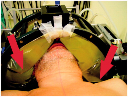 Figure 5. Patient in the HYPERcollar. Folds can be seen in the water bolus on both sides of the patient. The red arrows emphasise the folds that divide the water boluses into different sections and thereby block the water circulation. Also note the sticky tape that is used to create an air cavity for breathing.