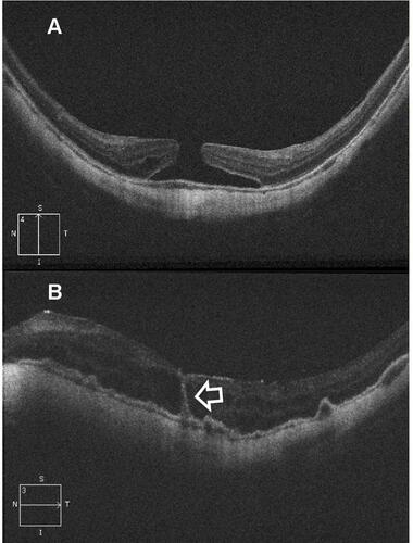 Figure 3 (A) High-definition 5-line raster OCT image of the left eye of a 46-year-old female with myopic FTMH. Note the OCT features of myopia as posterior bowing of the sclera, thinning of the choriocapillaris and dome-shaped macula. MLD of the hole was 328µ. Preoperative BCVA was 5/60. (B) Postoperative OCT image of the same patient taken at 1-month follow-up visit. The hole has closed though with interrupted ellipsoid zone. Note the hyporeflective intra-retinal cystic spaces. The hyperreflective vertical line traversing the neurosensory retina from the fovea to the RPE represents a track line which is a marker of previous injury to ELM layer and damage to the photoreceptors around the line (white arrow). The RPE is thickened and shows multiple pigment epithelial detachments. Postoperative BCVA remained 5/60.