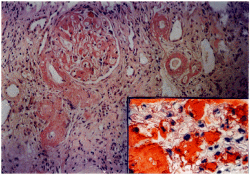 Figure 2. Deposits of amyloid in the glomeruli and vessels (×150). Inset shows immunohistochemically positive AA amyloid reactivity in a glomerulus (×300).