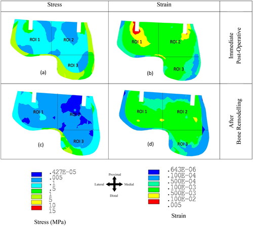 Figure 3. von Mises stress and strain distribution at the talus bone after the immediate post-operative and bone remodelling condition.