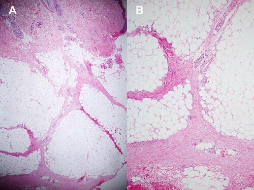 Figure 1 Histopathology of erythema nodosum; (A) Septal panniculitis without vasculitis (Hematoxylin-eosin stain, x40). (B) Higher magnification demonstrating septal fibrosis with lymphohistiocytic infiltration (Hematoxylin-eosin stain, x100).