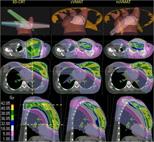 Figure 1. The left, Middle and right panels show beam arrangements and dose distributions from 3D-CRT, cVMAT and ncVMAT, respectively. The horizontal yellow lines at the sagittal view indicate the location of the transversal slices and vice versa for the yellow line at the transversal views. Dose color map is shown at the bottom left.